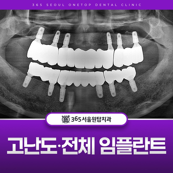 고난도 전체 임플란트는 365서울원탑치과의원에서