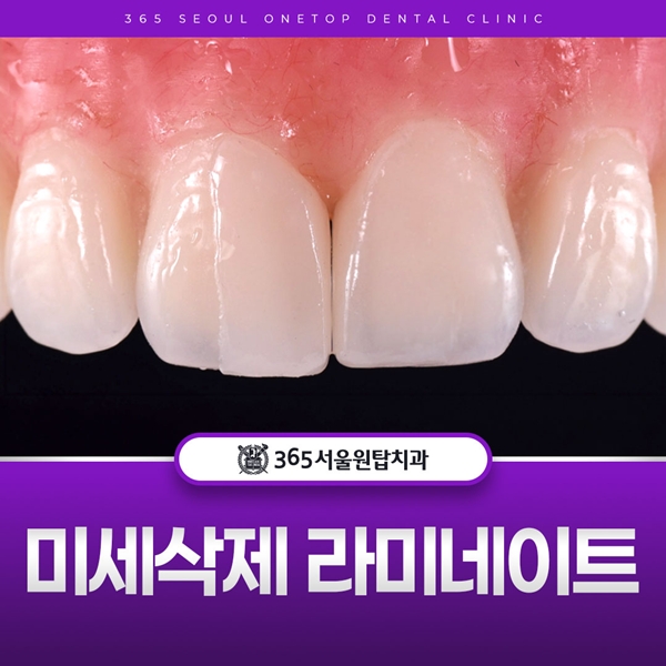 6. 미세삭제 라미네이트.jpg