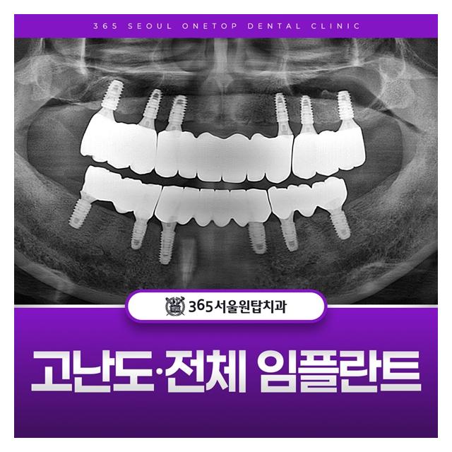 고난도, 전체 임플란트도 잘하는 병원