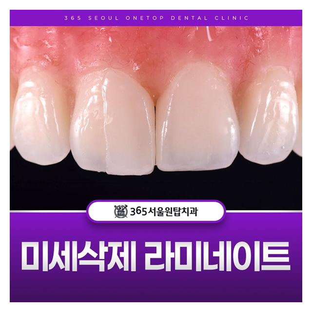 미세삭제 라미네이트로 환하게 웃으세요